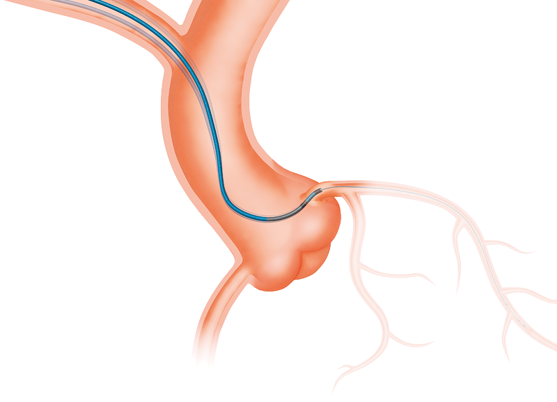 Heartrail® II PTCA guiding catheter